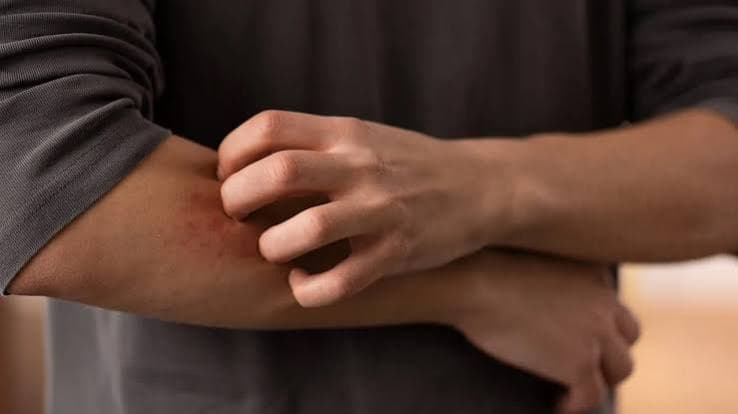 Aumento dei casi di dermatofilosi in Europa: Pregliasco rassicura, ma le modalità di contagio stanno evolvendo